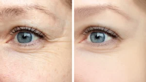 botox bucuresti