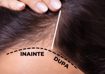 mezoterapie scalp bucuresti