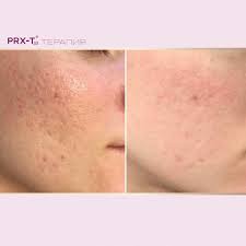 Prx T33 peeling facial Bucuresti